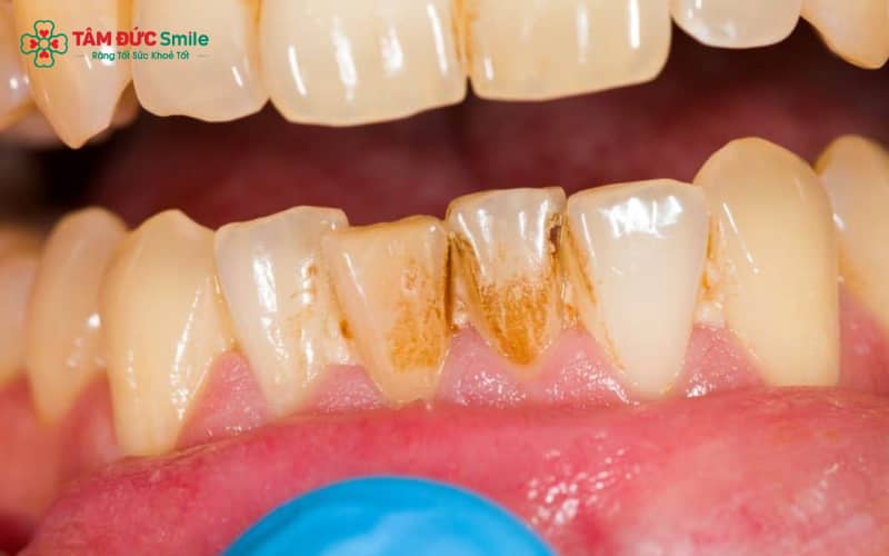 Vôi răng có thể xuất hiện ở cả trên đường viền nướu và bên dưới nướu