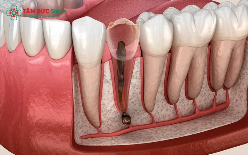 Các dấu hiệu như ê buốt chân răng, sưng nướu là cảnh báo cần thăm khám nha khoa sớm