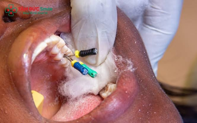 Điều trị tủy và phục hình là giải pháp giúp bảo tồn răng thật thay vì phải nhổ bỏ