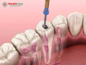 Chân răng là gì? Cấu tạo, bệnh thường gặp và cách điều trị hiệu quả