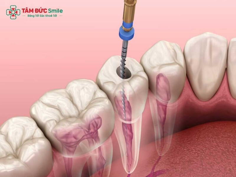 Chân răng là gì? Cấu tạo, bệnh thường gặp và cách điều trị hiệu quả