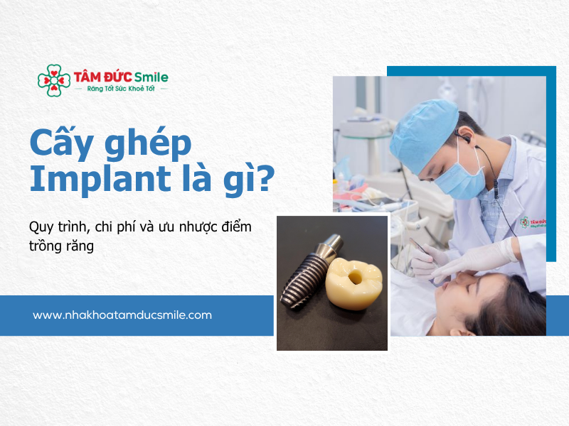 cay-ghep-implant