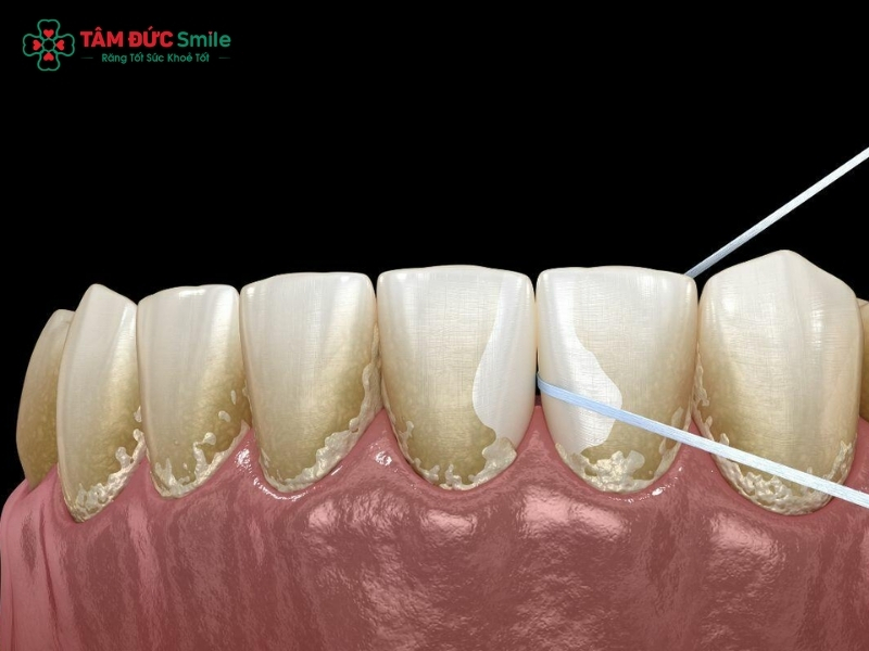 Các bước dùng chỉ nha khoa đúng cách