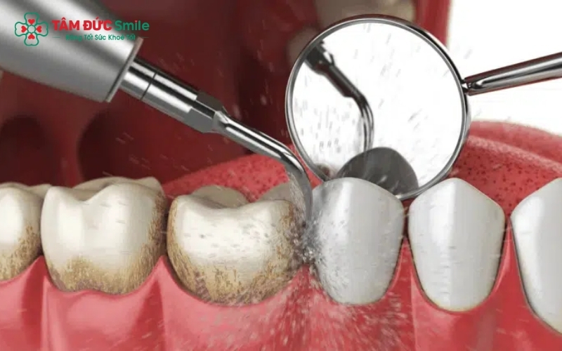 Sử dụng công nghệ sóng siêu âm hiện đại giúp loại bỏ mảng bám cứng đầu một cách nhẹ nhàng, hạn chế tối đa cảm giác ê buốt và tổn thương nướu