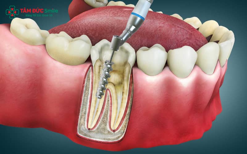 Bác sĩ tiến hành làm sạch răng miệng kỹ lưỡng trước khi điều trị tủy răng số 7, giúp kiểm soát nguy cơ nhiễm khuẩn
