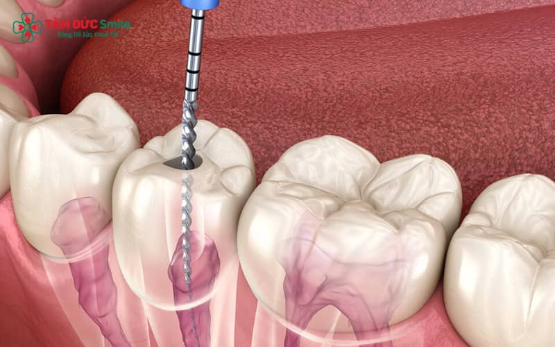 Mức phí điều trị tủy răng số 7 thay đổi tùy theo tình trạng bệnh lý và số lượng ống tủy