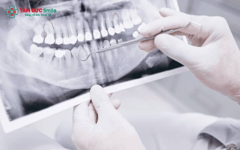 Kỹ thuật chụp X-quang răng cho phép bác sĩ theo dõi toàn diện cấu trúc răng, xương hàm và các mô liên quan