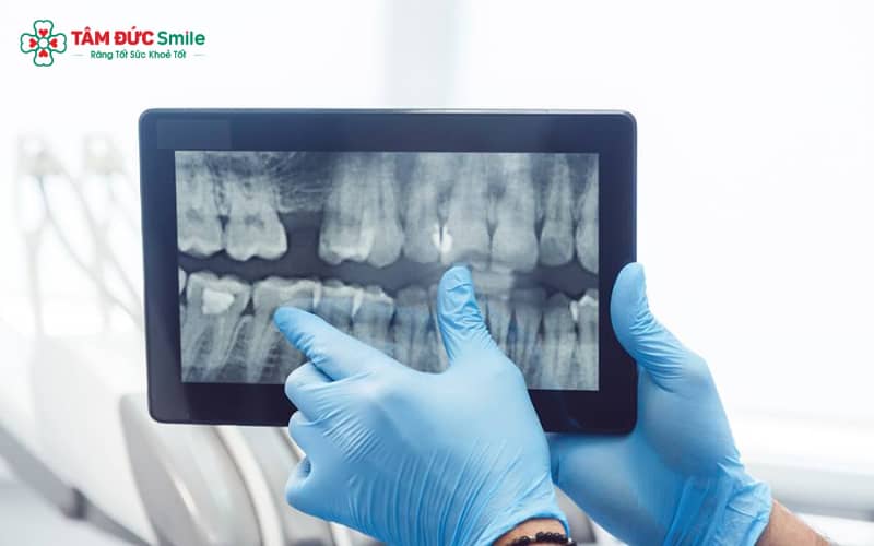 Kỹ thuật chụp X-quang răng hỗ trợ bác sĩ chẩn đoán sớm tình trạng răng mọc lệch, mọc ngầm và nhiều bệnh lý nha khoa