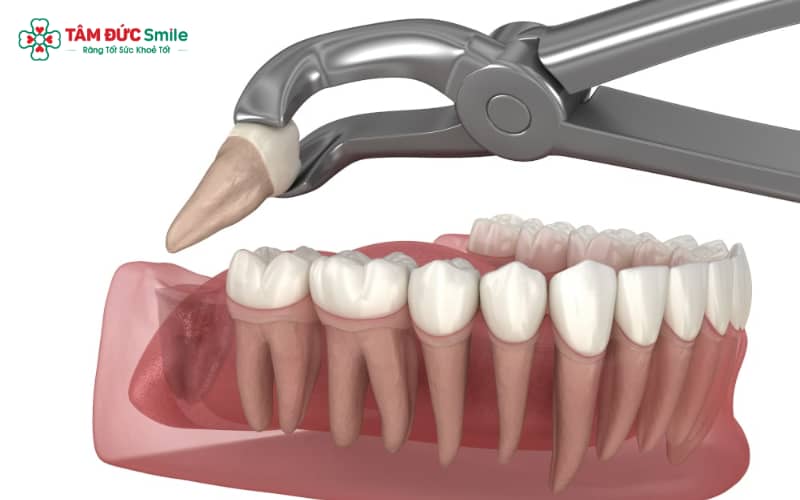 Nhổ răng khôn là thủ thuật nha khoa nhằm loại bỏ răng số 8 khi răng mọc lệch hoặc mọc ngầm