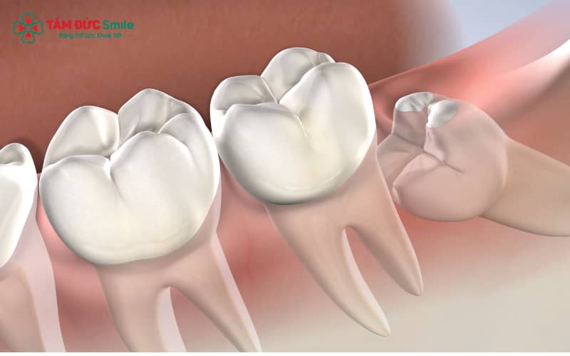 Nhổ răng khôn là một thủ thuật tiểu phẫu thường được thực hiện trong nha khoa