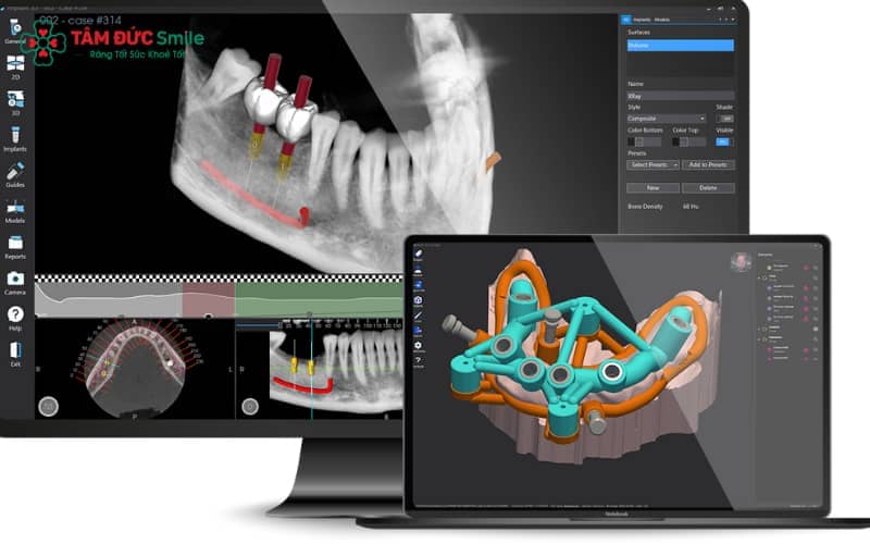 Công nghệ định vị cấy ghép Implant 3D tiên tiến, hỗ trợ lập kế hoạch chuẩn xác và giám sát trực quan bằng camera trực tiếp