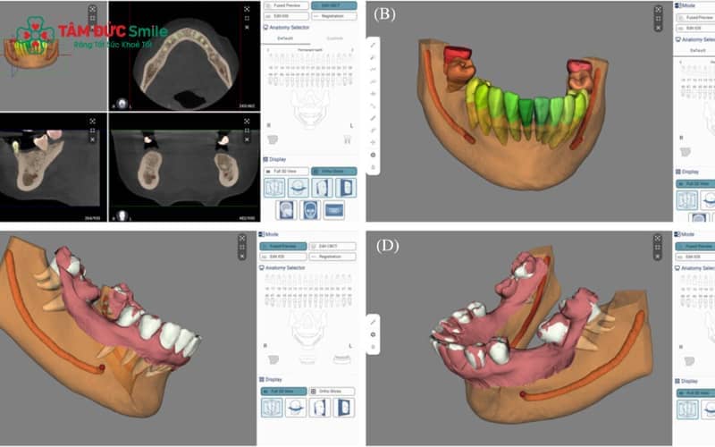 Ứng dụng phần mềm mô phỏng 3D, bác sĩ tính toán và định hướng vị trí, góc cắm và chiều dài phù hợp nhất cho trụ Implant