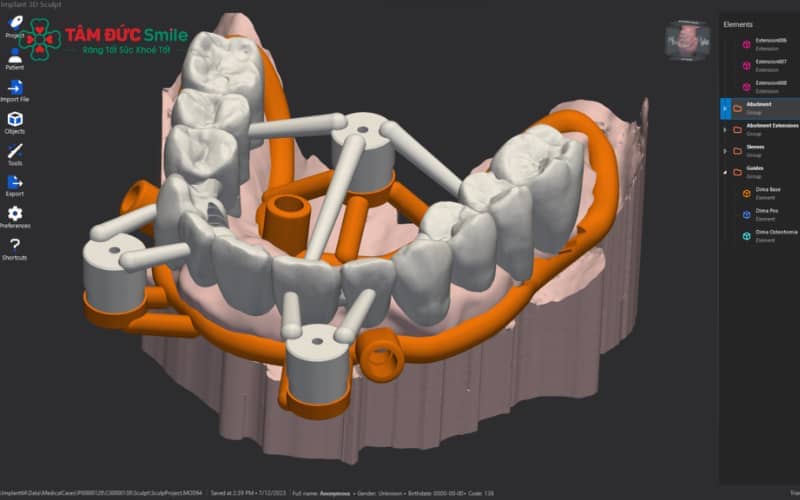 Hệ thống định vị Implant 3D tối ưu hóa quy trình, đảm bảo độ chính xác cao hơn hẳn so với cách làm truyền thống