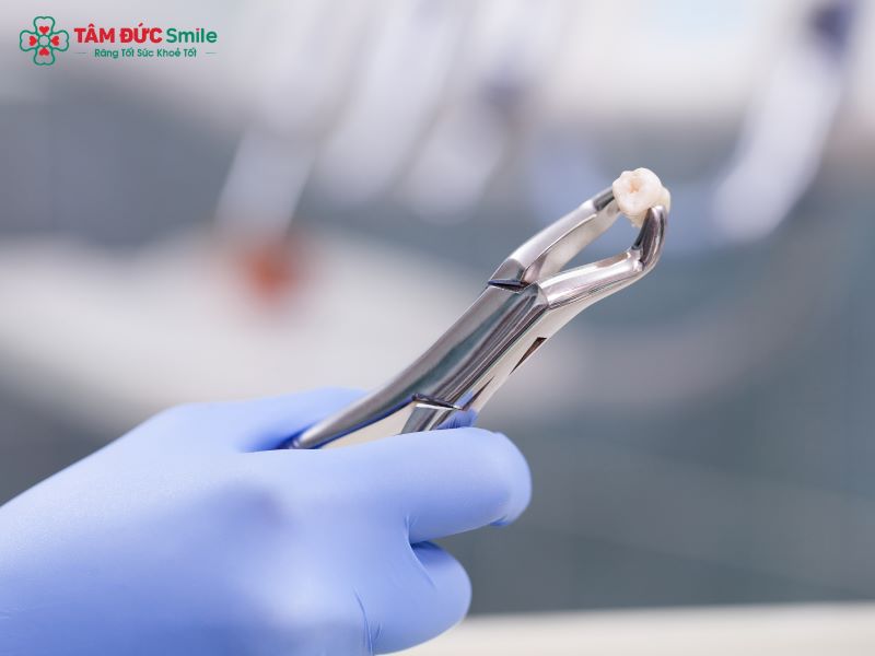 Bác sĩ thường chỉ định nhổ răng khôn mọc lệch, mọc ngầm hoặc gây viêm nhiễm để ngăn ngừa biến chứng răng miệng.