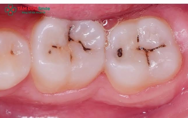Đốm trắng đục trên bề mặt răng là dấu hiệu sâu răng sớm nhất mà bạn không nên bỏ qua.