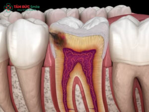 Dấu hiệu sâu răng thường gặp và cách điều trị hiệu quả