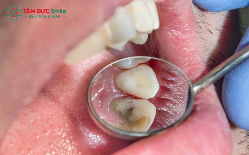 Nếu không điều trị, sâu răng sẽ dẫn đến viêm tủy và áp xe, gây đau nhức dữ dội và đe dọa mất răng.
