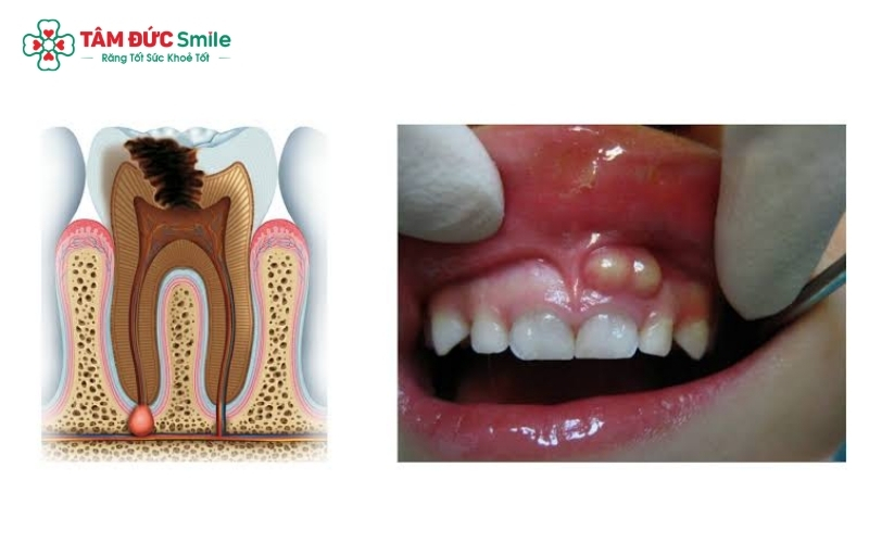 Sâu răng đến tủy thường đi kèm với lỗ sâu đen và những cơn đau nhức dữ dội, đặc biệt là về đêm.