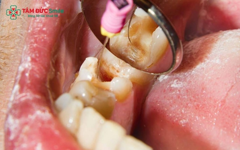 Răng sâu vào tủy không thể tự khỏi. Khi cơn đau giảm đột ngột, đó là dấu hiệu tủy đã chết, cần can thiệp ngay.