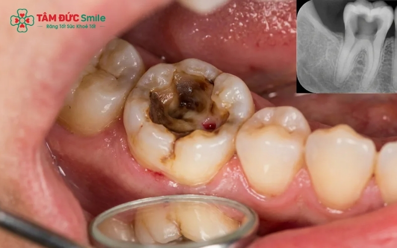 Viêm tủy kéo dài dẫn đến viêm quanh chóp và áp xe, đe dọa mất răng vĩnh viễn.