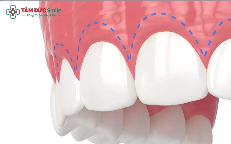 Điều trị cười hở lợi tại Tâm Đức Smile nhẹ nhàng, an toàn và đảm bảo tính thẩm mỹ cao.