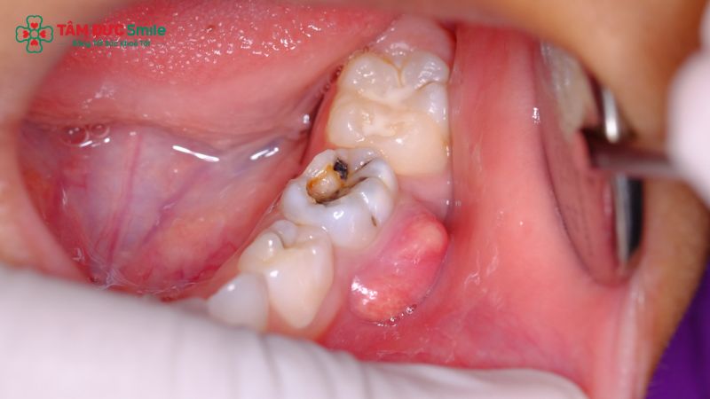 Răng sâu tiến vào buồng tủy có thể gây viêm và cần được đánh giá để chỉ định điều trị tủy phù hợp.