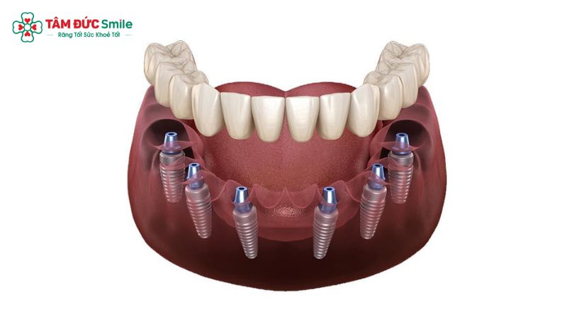 implant-all-on-6-la-gi-1