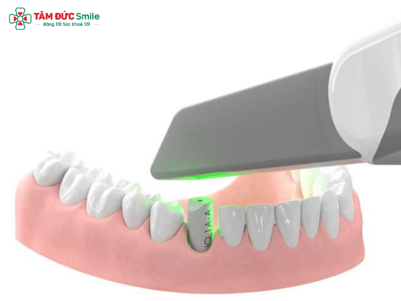 implant-scan-body-1