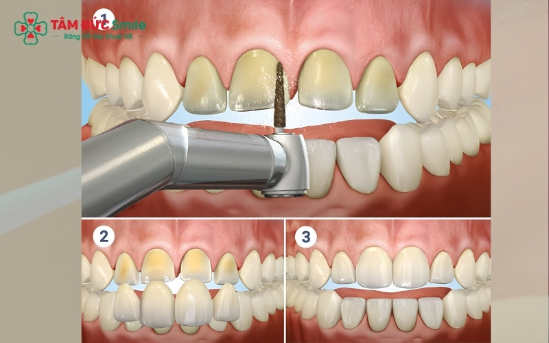 Bọc răng sứ giúp tái tạo hình thể và màu sắc, mang lại nụ cười tự tin mà vẫn bảo tồn mô răng thật