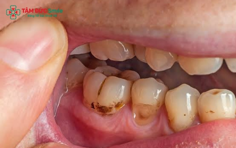 Bác sĩ kiểm tra tình trạng răng và khớp cắn để xác định phương pháp phục hình tối ưu nhất.