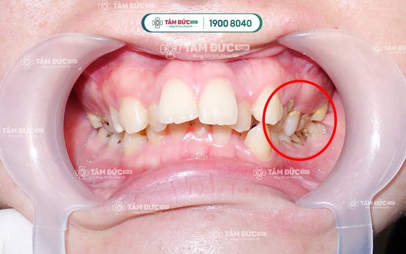 Để đảm bảo an toàn, lấy cao răng phải do nha sĩ có trình độ chuyên môn thực hiện