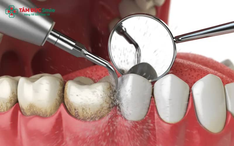 Chi phí dịch vụ lấy cao răng tại phòng khám uy tín thường khoảng 200.000 – 500.000 VNĐ/lần