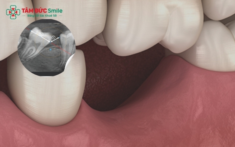 Để mất răng số 7 lâu ngày dẫn đến hệ lụy: răng xô lệch, tiêu xương và sai lệch khớp cắn toàn hàm.