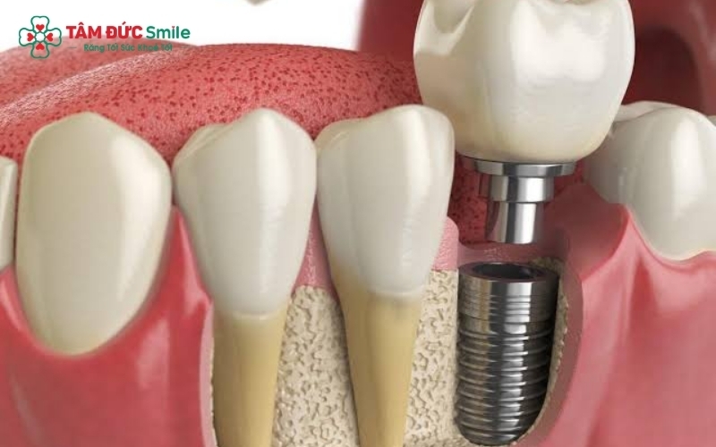 Các phương pháp phục hình răng số 7 hiện nay tại Nha khoa Tâm Đức Smile implant là lựa chọn tối ưu nhất.