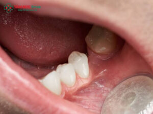 Mất răng số 7 có ảnh hưởng gì? Phương pháp phục hình răng số 7