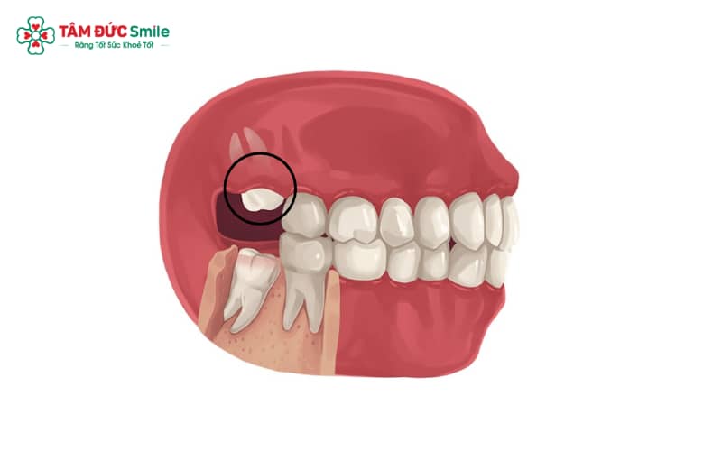Quá trình mọc răng khôn hàm trên có thể đi kèm tình trạng khó chịu như đau, viêm sưng nướu, nhức đầu hoặc sốt nhẹ
