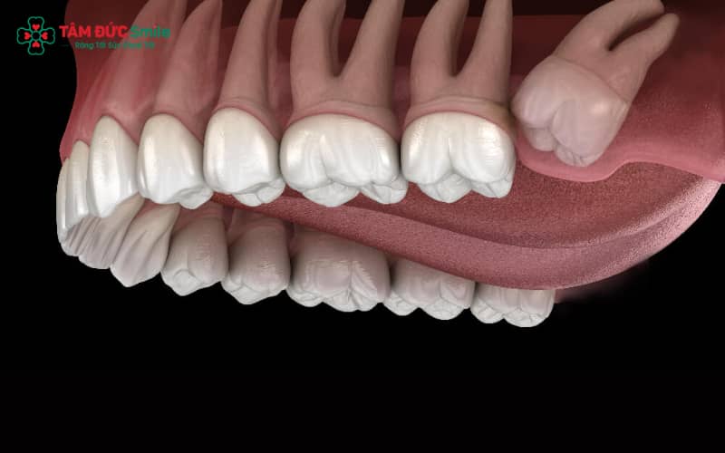 Giữ vệ sinh răng miệng thường xuyên giúp hạn chế đau nhức khi răng khôn mọc lệch