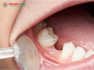 Nên trồng răng loại nào? So sánh Implant, cầu răng sứ và hàm giả