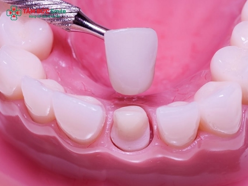 Nha khoa thẩm mỹ gồm những dịch vụ nào? Bảng giá chi tiết