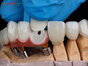 nhược điểm cầu răng sứ