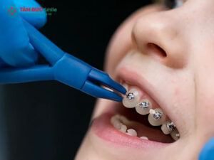 Niềng răng có phải nhổ răng không? Khi nào cần nhổ răng khi niềng?