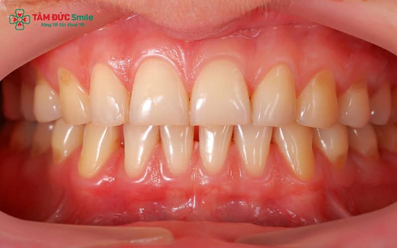 Nướu răng thuộc hệ thống niêm mạc miệng, có cấu trúc ôm sát răng và bao phủ xương ổ răng