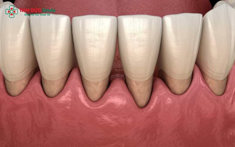Nướu đóng vai trò quan trọng trong việc liên kết, bảo vệ và duy trì sự ổn định của răng