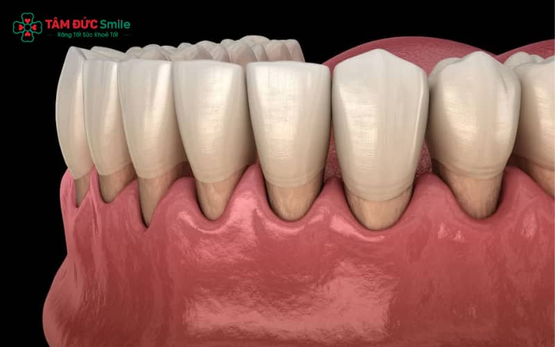Tình trạng của nướu là thước đo quan trọng để đánh giá sức khỏe răng miệng