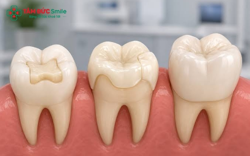 Bọc sứ hay dán Veneer? Lựa chọn phương pháp phù hợp dựa trên tình trạng mô răng của bạn.
