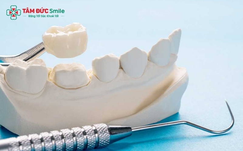 Răng toàn sứ cao cấp: Giải pháp tối ưu về thẩm mỹ, độ bền và an toàn cho nướu.