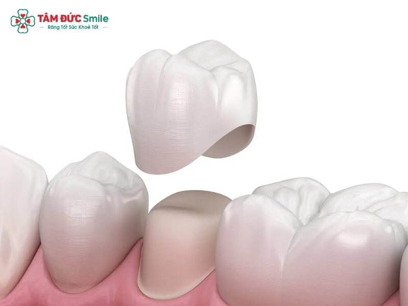Phục hình răng sứ là gì? Quy trình, chi phí và phương pháp phổ biến