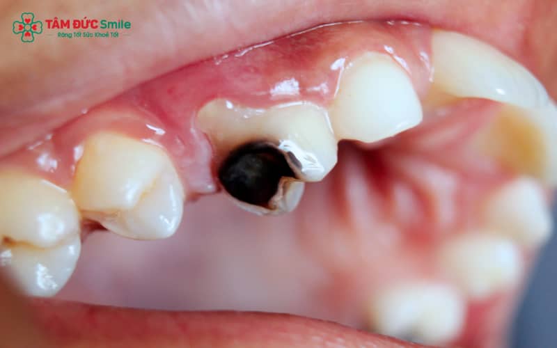Răng đổi màu đen không chỉ ảnh hưởng đến ngoại hình mà về lâu dài còn gây tác động xấu đến sức khỏe răng miệng