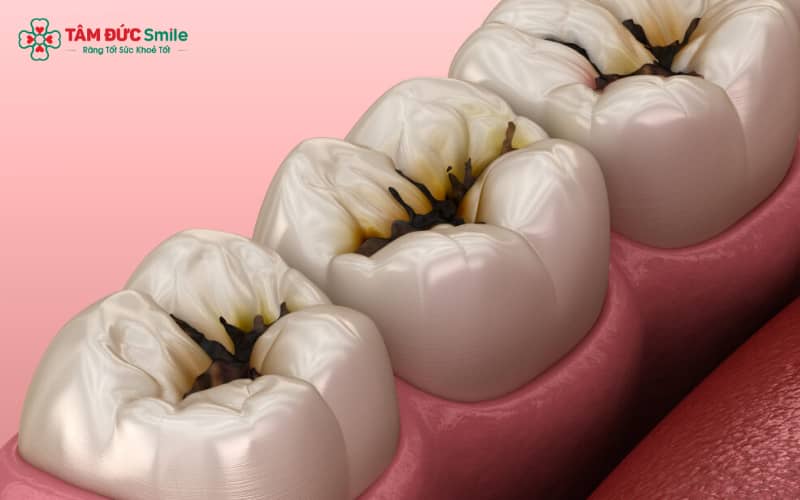 Đốm đen ở răng là triệu chứng thường gặp của sâu răng, đặc biệt khi tổn thương đã khoáng hóa