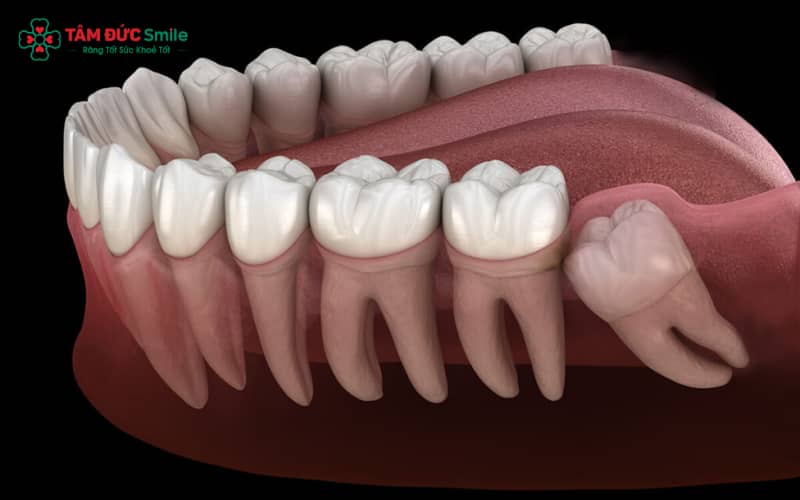 Răng khôn được xác định là răng mọc tại vị trí trong cùng của mỗi bên cung hàm